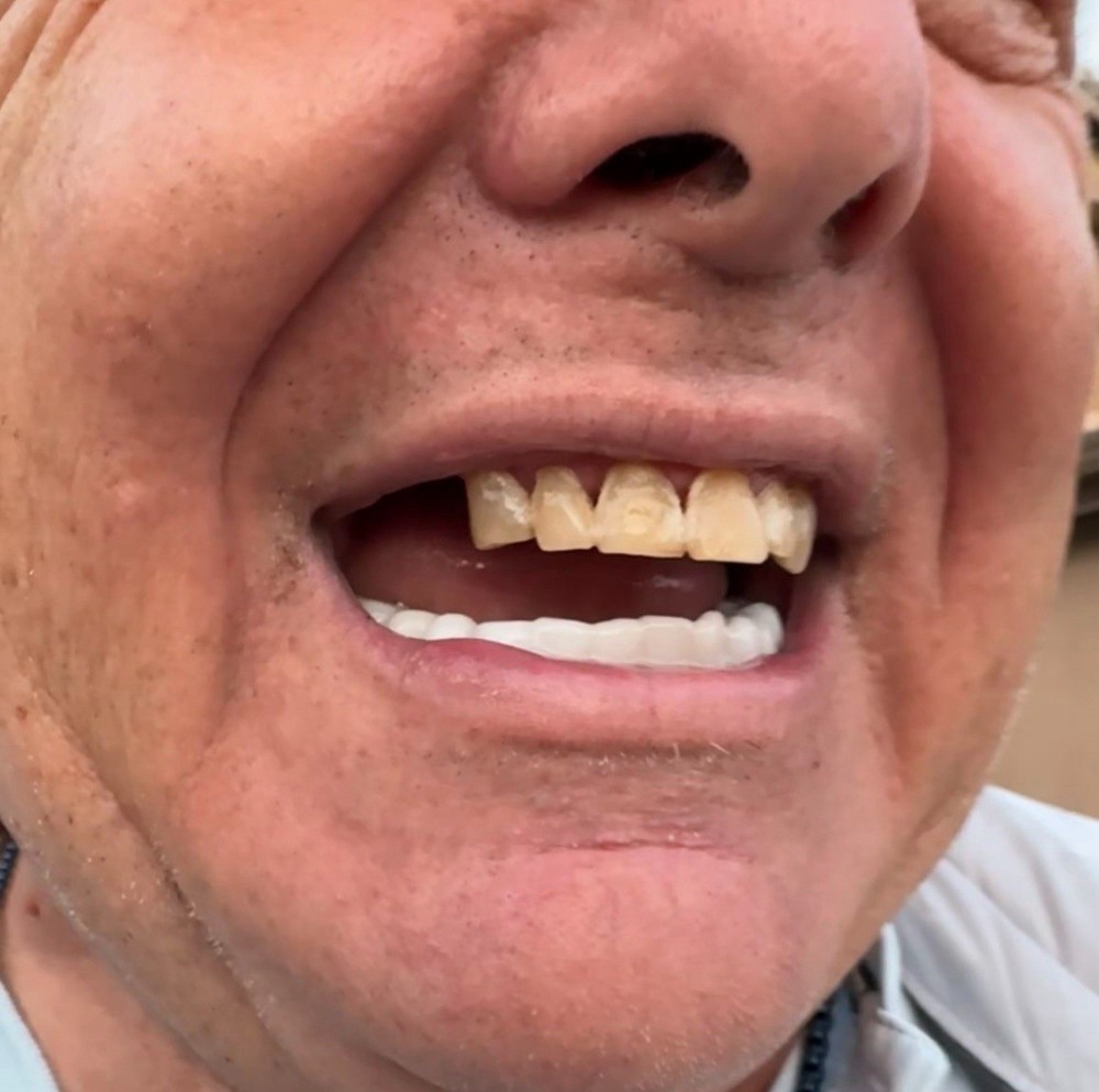 Custom Upper or Lower Cosmetic Click on Veneer