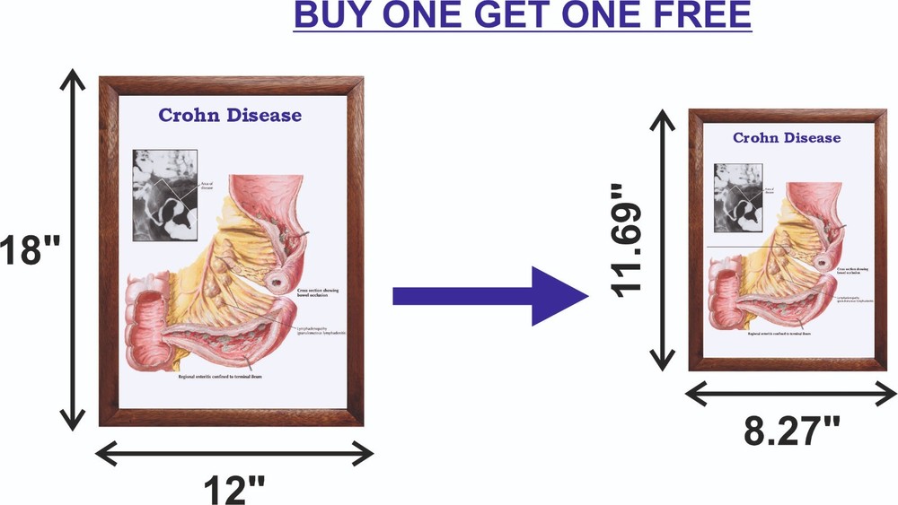Crohn Disease Chart 12x18 inches