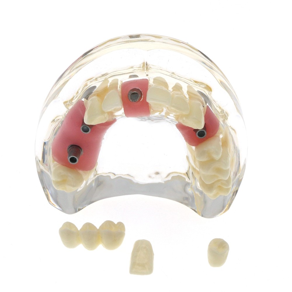 Detal Typondont Restoration Implant Teeth Model 2 3 4 Implants For Studying