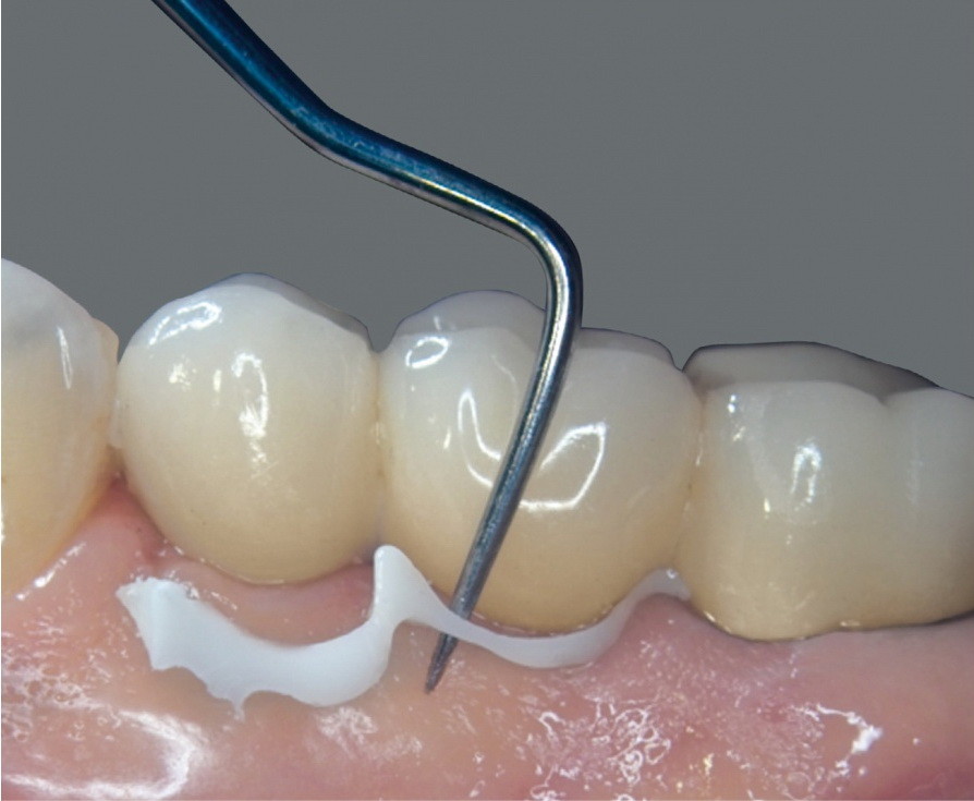 Dental Cement Impla-Cem semi permanent dual curing removable 5ml/8.6gr