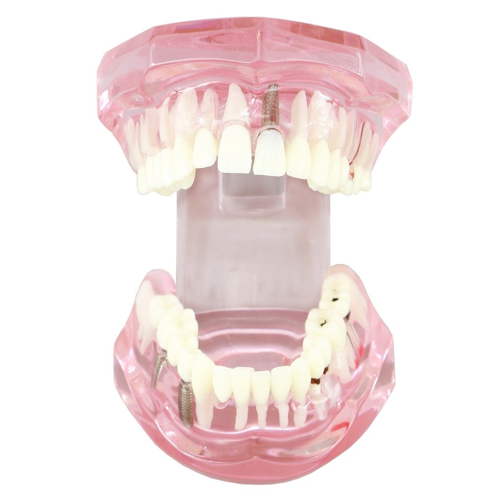 Dental Model Teeth Implant Restoration Bridge Teaching Study Dentist Dentistry