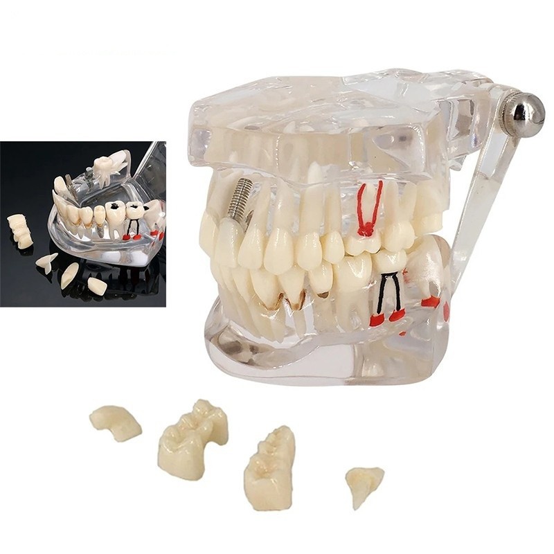 Dental Removable Restoration &Implant Pathological Disease Teeth Study Model