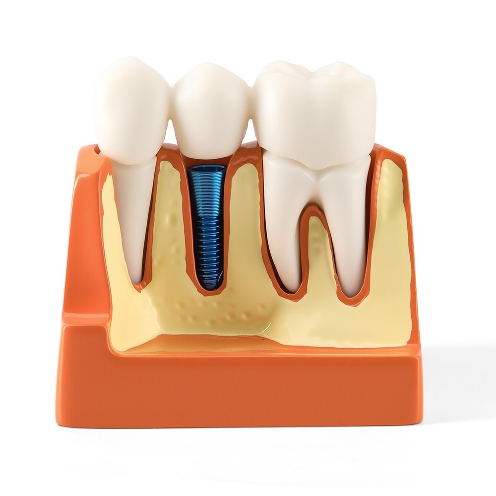 4 Times Dental Analysis Crown Bridge Demonstration Removable Teaching Model