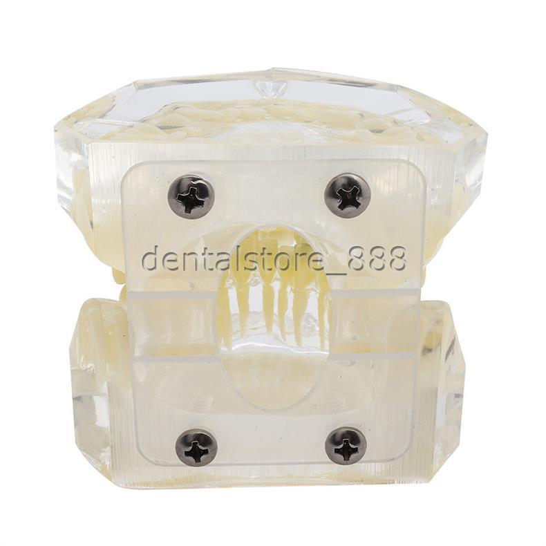 Dental Typodont Orthodontic Treatment Teeth Model Malocclusion Study w/ Bracket
