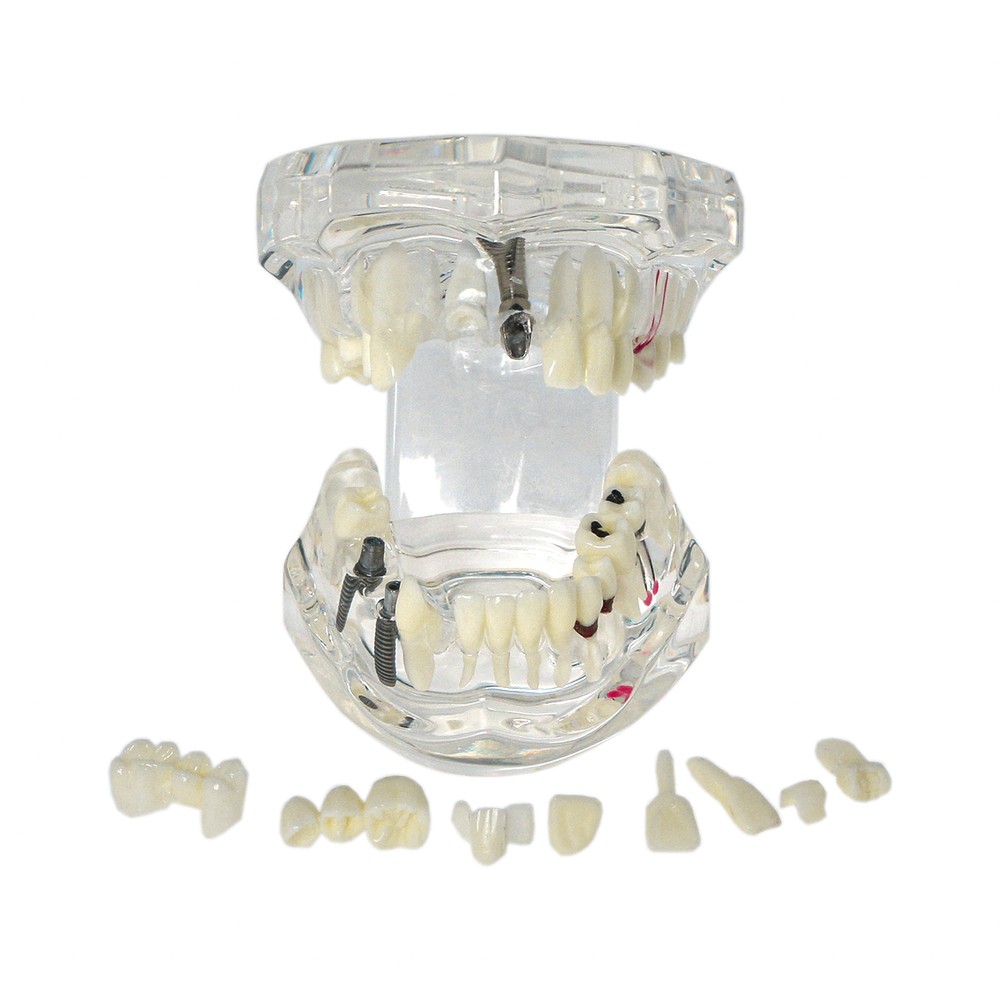 Multi-Type Dental Teaching Typodont Model Ortho/Implant/Pathology Practice Demo