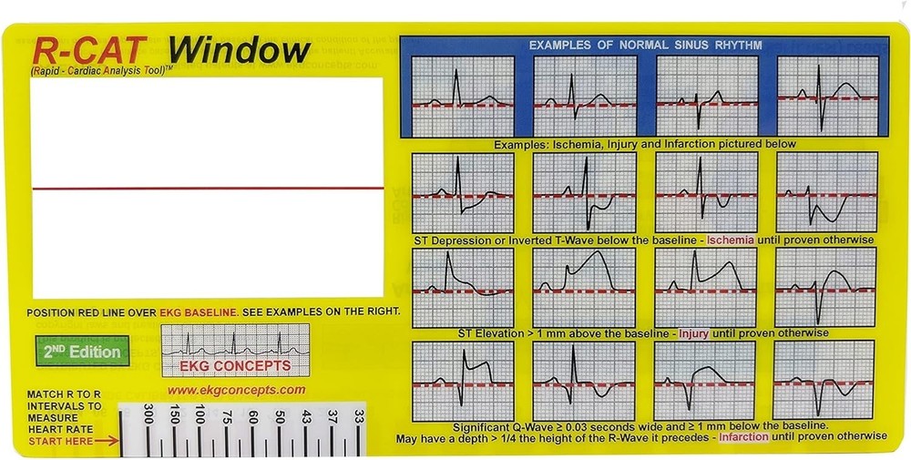 EKG Window 2nd Edition