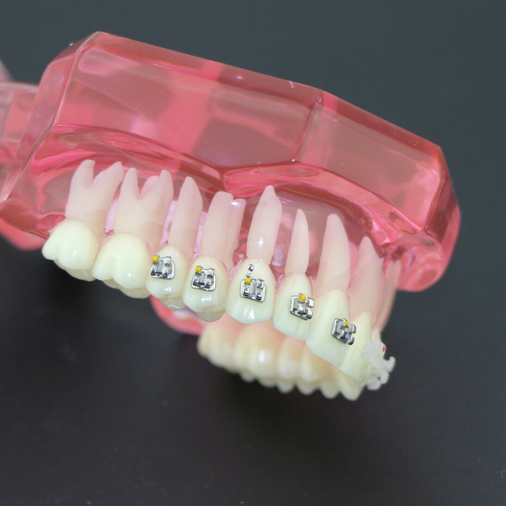Dental Orthodontic Demonstration Ceramic and Metal Bracket Study Typodont Model