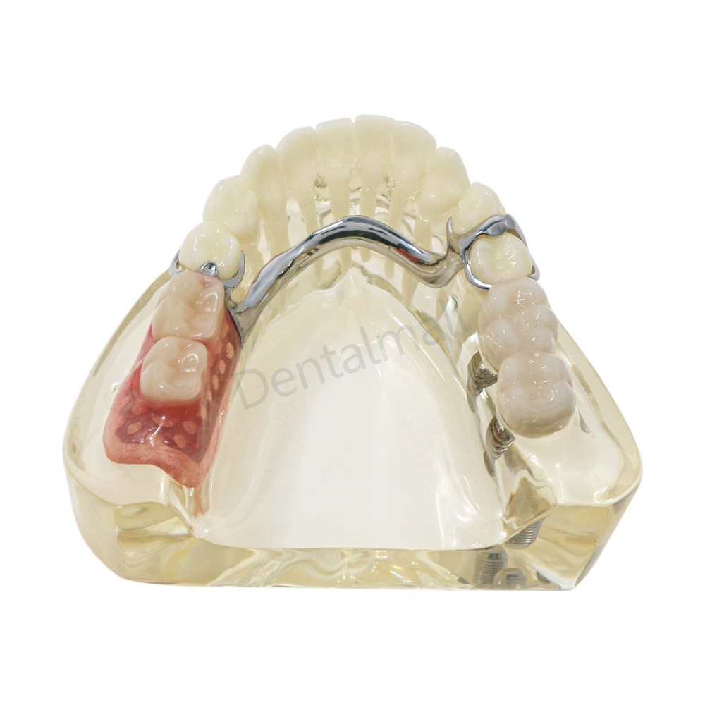 Dental Typodont Restoration Model With 2 Implants Partial Denture Demo
