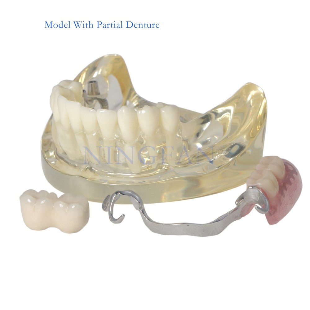 Dental Implant RPD Restoration Model Removable Partial Denture Lower 2 Implants