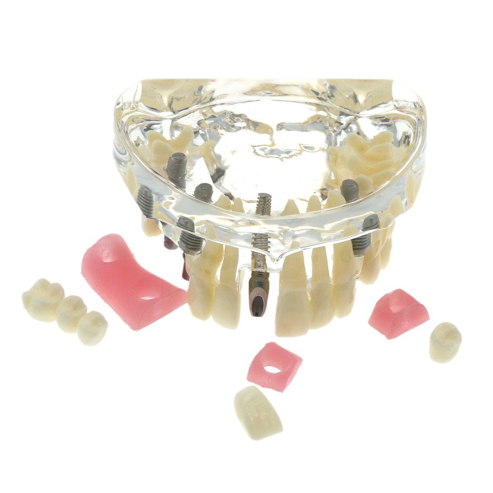 Detal Typondont Restoration Implant Teeth Model 2 3 4 Implants For Studying