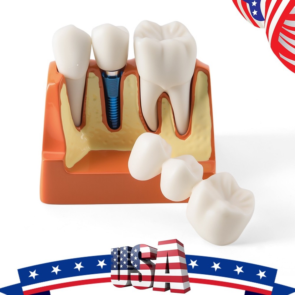 4 Times Dental Teeth Model Implant Crown Bridge Removable Study Teaching Tool