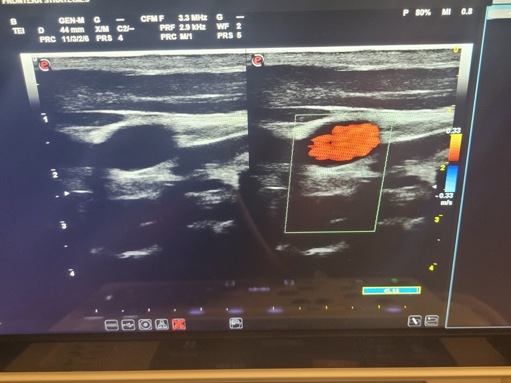 Esaote AL 2442 Linear Array Ultrasound Transducer