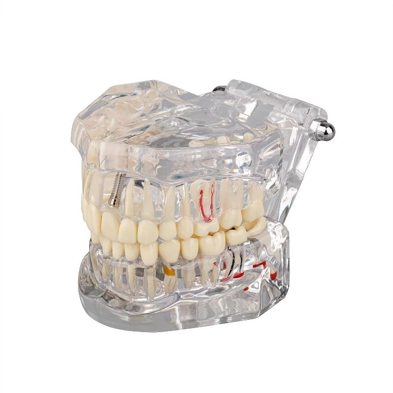 Medical Pathological Extrusion Missing Teeth Model Dental Teaching Teeth Model