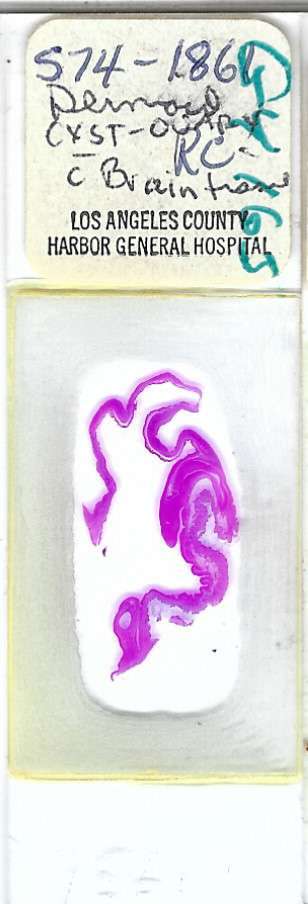 Human Dermoid Cyst with Brain Tissue Pathology Microscope Slide