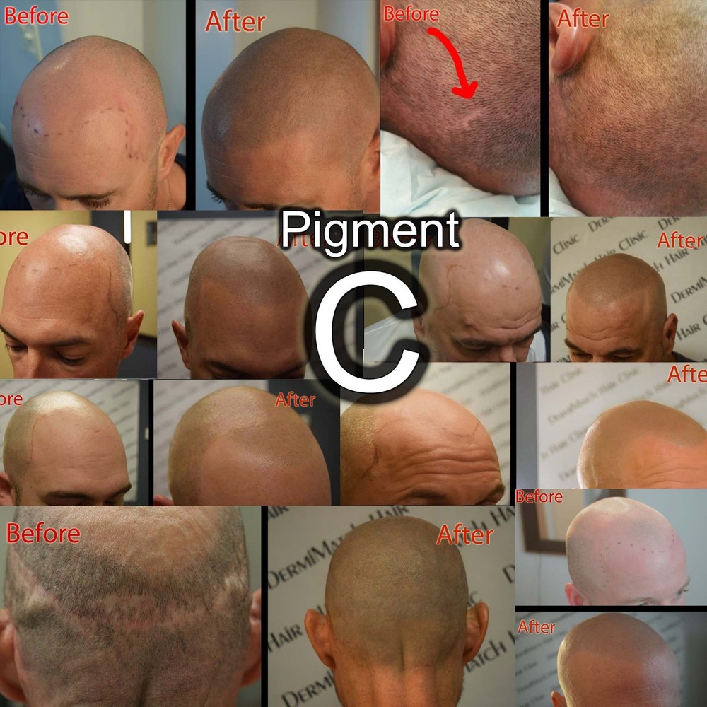 HD Scalp Micropigmentation Kit by DermiMatch
