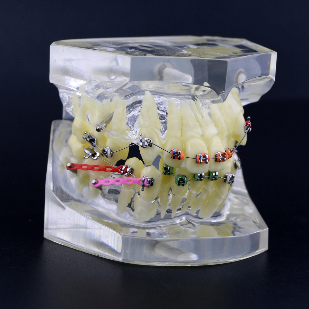 Dental Typodont Orthodontic Treatment Teeth Model Malocclusion Study w/ Bracket