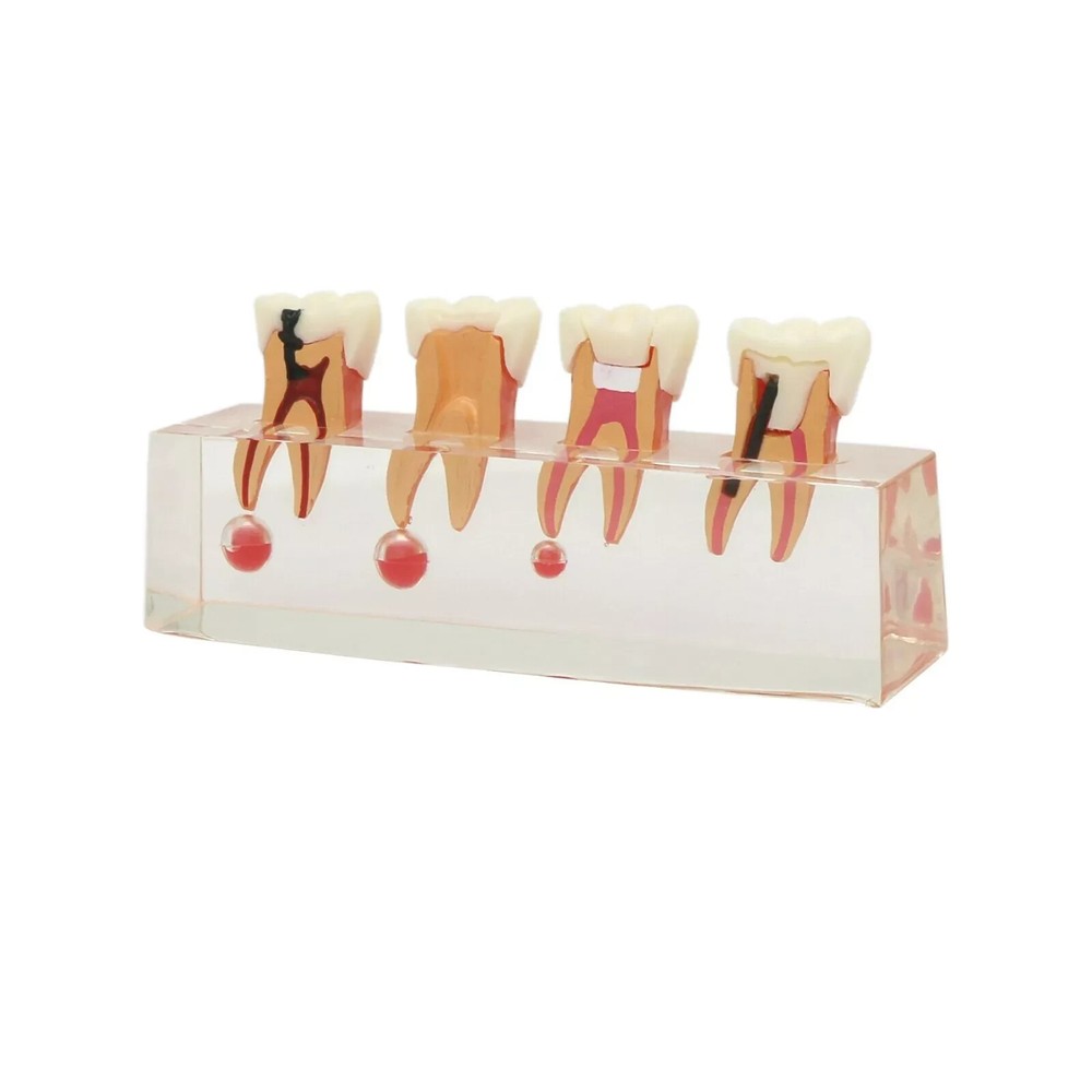 Dental Endodontic Treatment Study Teaching Typodont Teeth 4018 Model 4 Stage