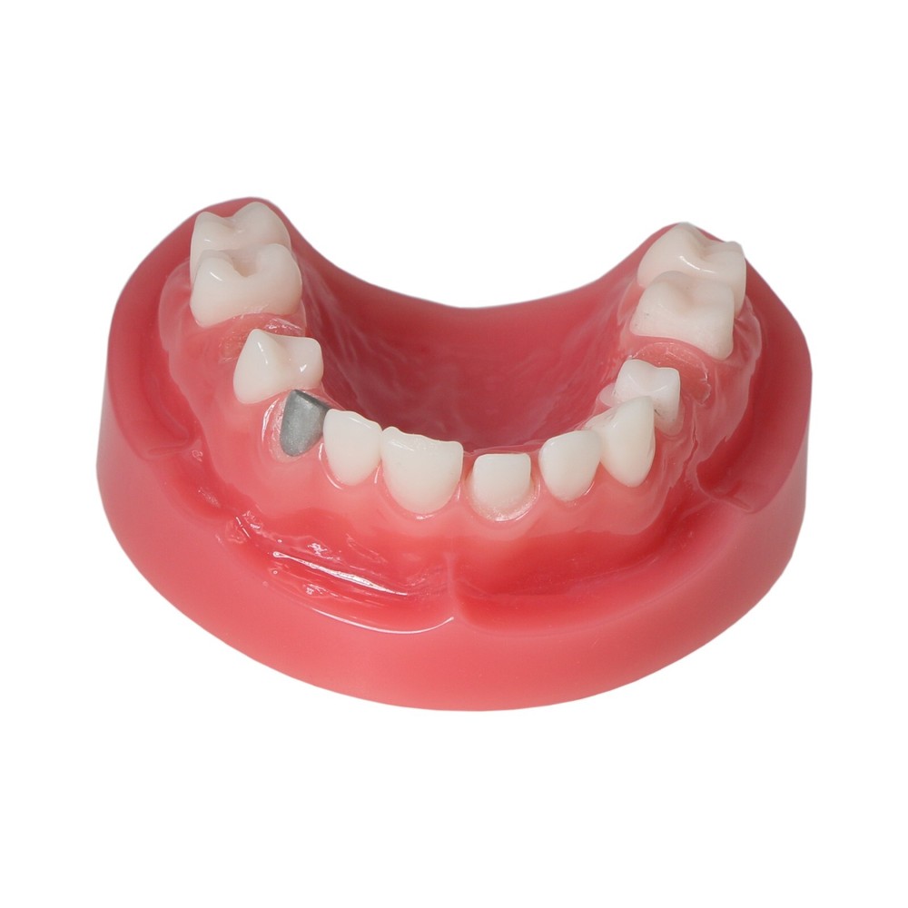 Dental Implant Disease Teeth Model Overdenture Implants Upper/Lower Demo