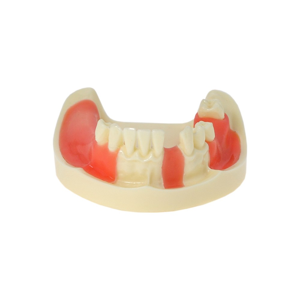 Implant Teeth Model Dental Typodont Ortho Pathological Perio Practice Demo Model