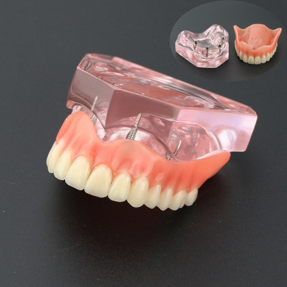 Dental Teeth Model Demo Overdenture Restoration With 4 Implants Upper Maxillary