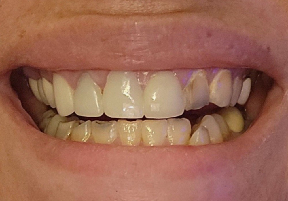 Custom Upper or Lower Cosmetic Click on Veneer