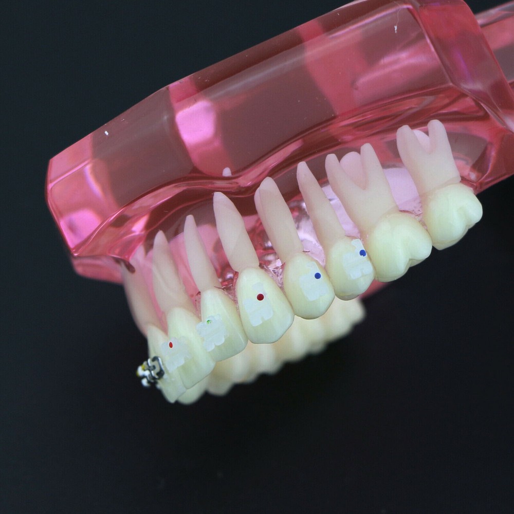 Dental Orthodontic Demonstration Ceramic and Metal Bracket Study Typodont Model