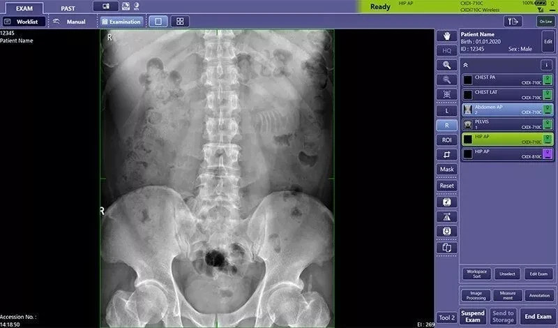digital mobile wireless radiology machine DR canon portable