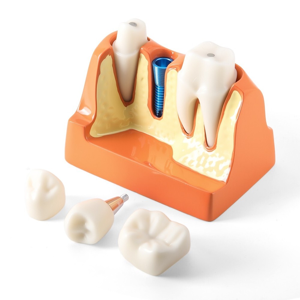 4 Times Dental Analysis Crown Bridge Demonstration Removable Teaching Model