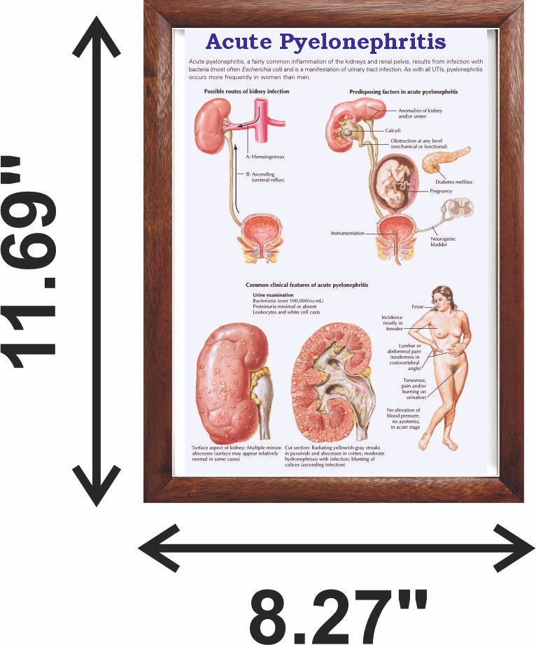 Acute Pyelonephritis Chart 12x18 inches