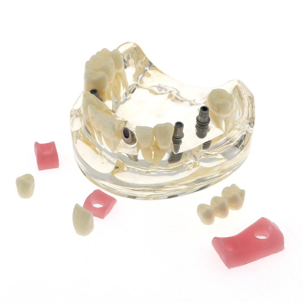 Detal Typondont Restoration Implant Teeth Model 2 3 4 Implants For Studying