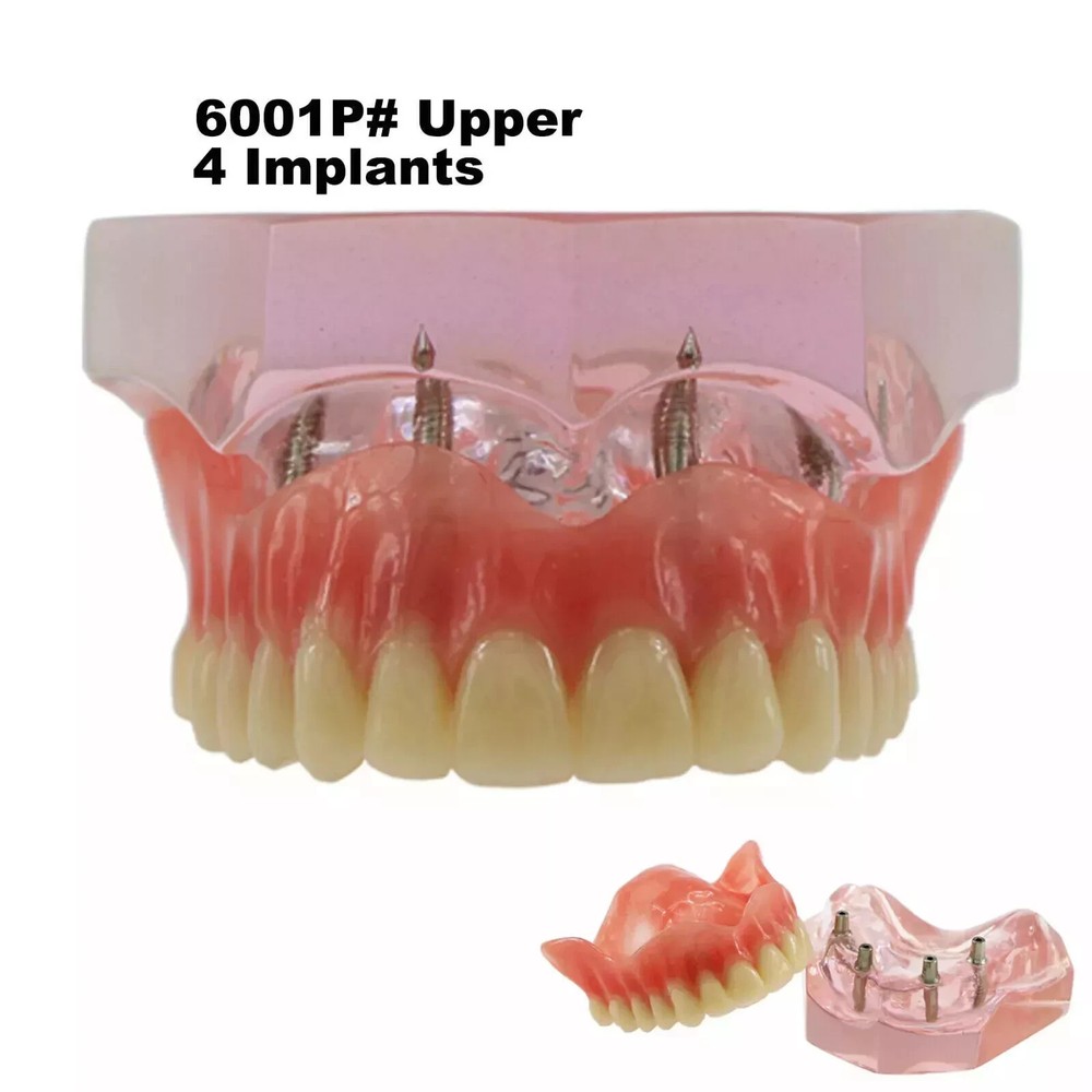 7 Types Dental Overdenture Restoration Model Implants Typodont Teaching Study