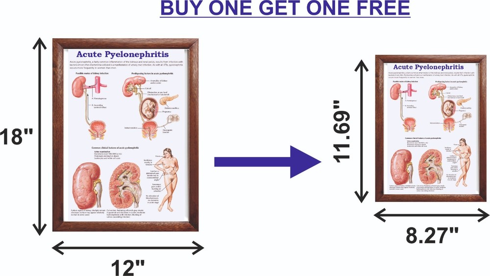 Acute Pyelonephritis Chart 12x18 inches