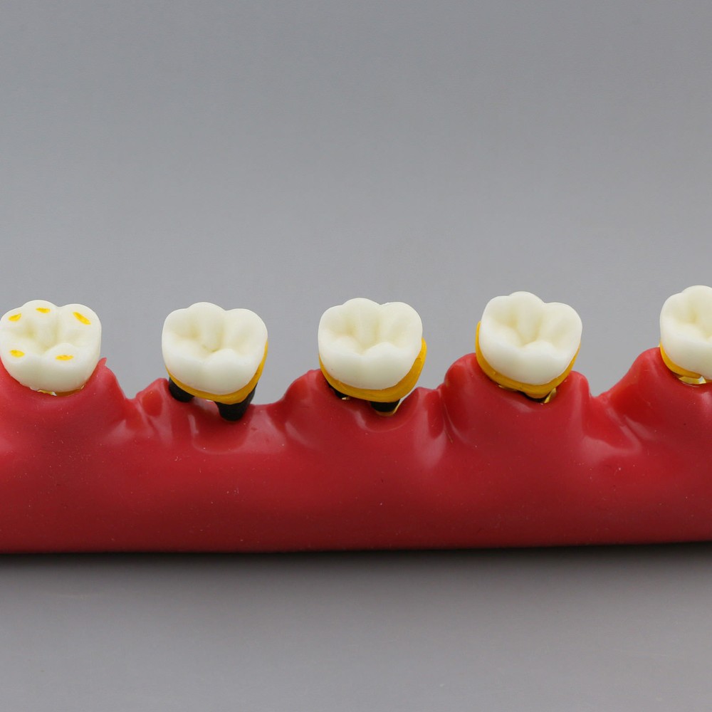 Dental Study Teaching Model Periodontal Disease Assort Teeth Dentoform Typodont