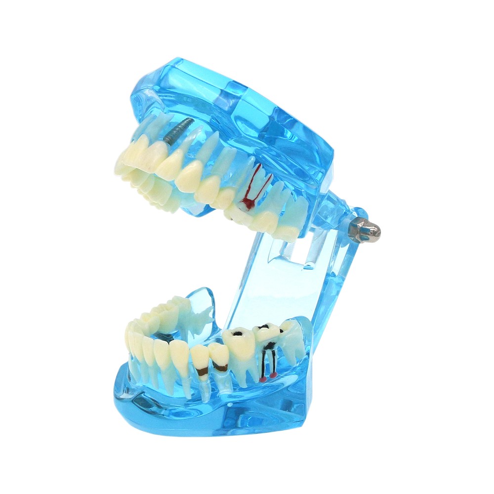 Dental Implant Teeth Model Restoration Pathology Teach Study Demo Removable