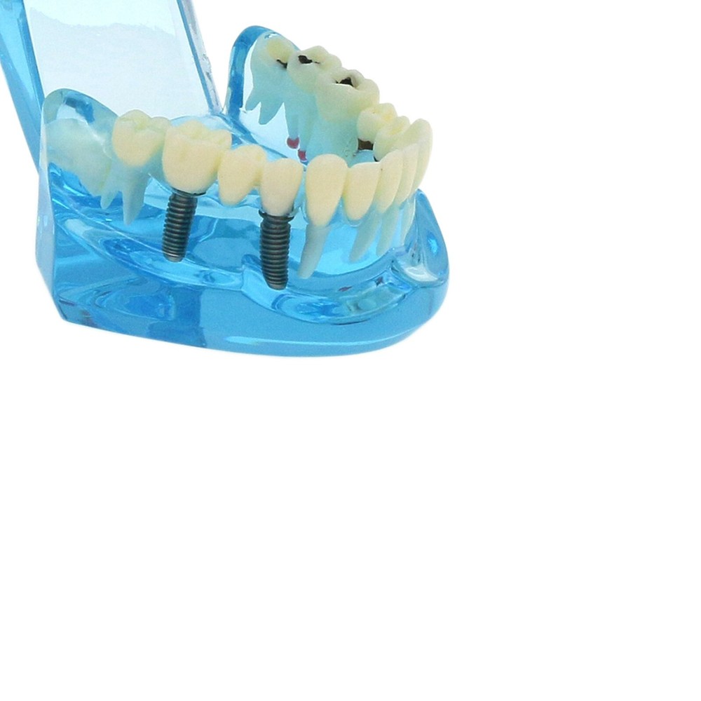 Dental Teeth Model Implant Bridge Restoration Pathology Study Demo Removable