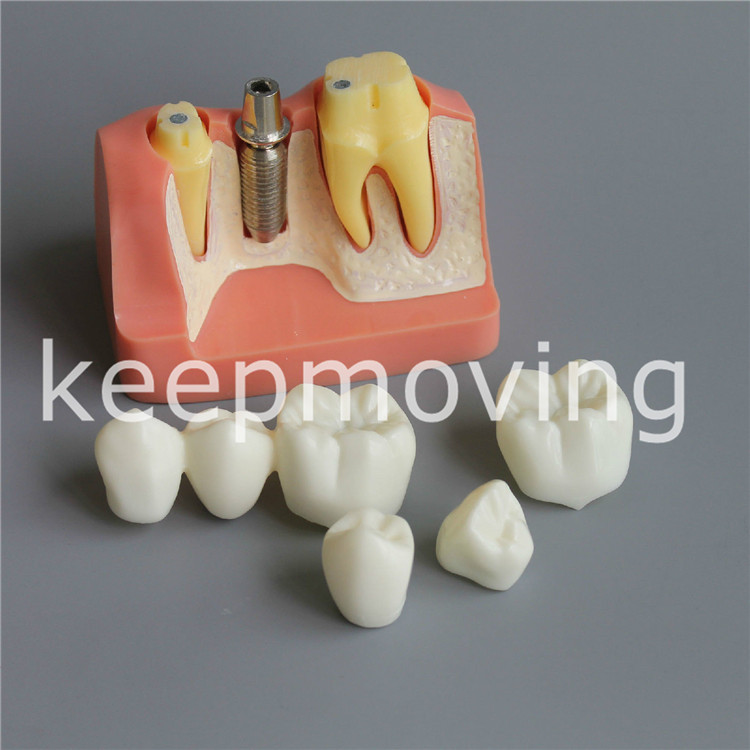 Dental Implant Analysis Crown Bridge Demonstration Teeth Tooth Model Typodont