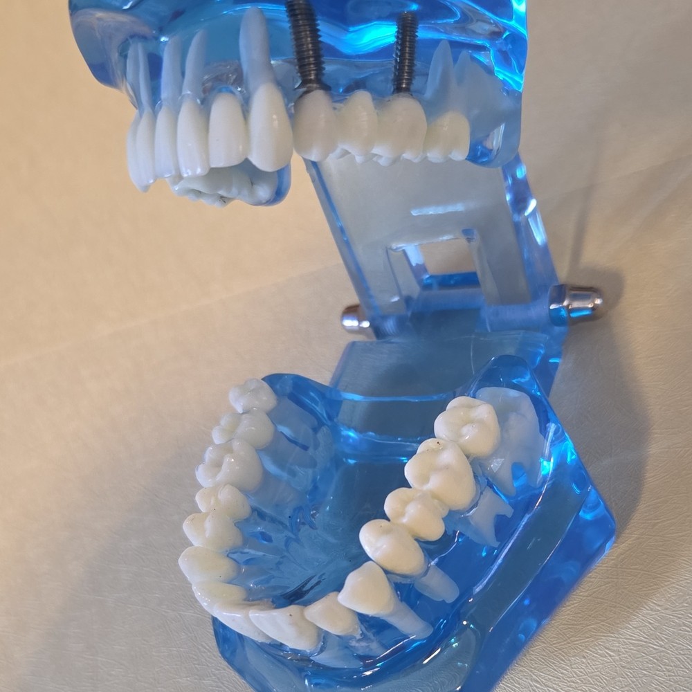 Typodont Dental Model with Removable Teeth, Implants, Blue Transparent Base