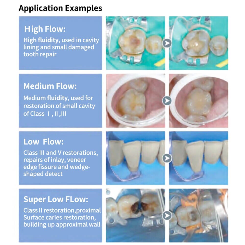 Dental Flowable Composite 3g Syringe Light Curing, Low Flow, 4 Shades Available