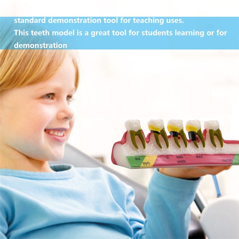 Dental Study Teaching Model Periodontal Disease Assort Teeth Dentoform Typodont