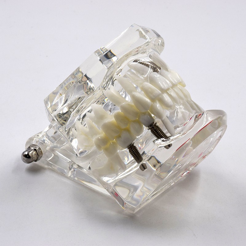 Dental Teeth Model With Restoration&Bridge Implant Disease Study Teaching Model