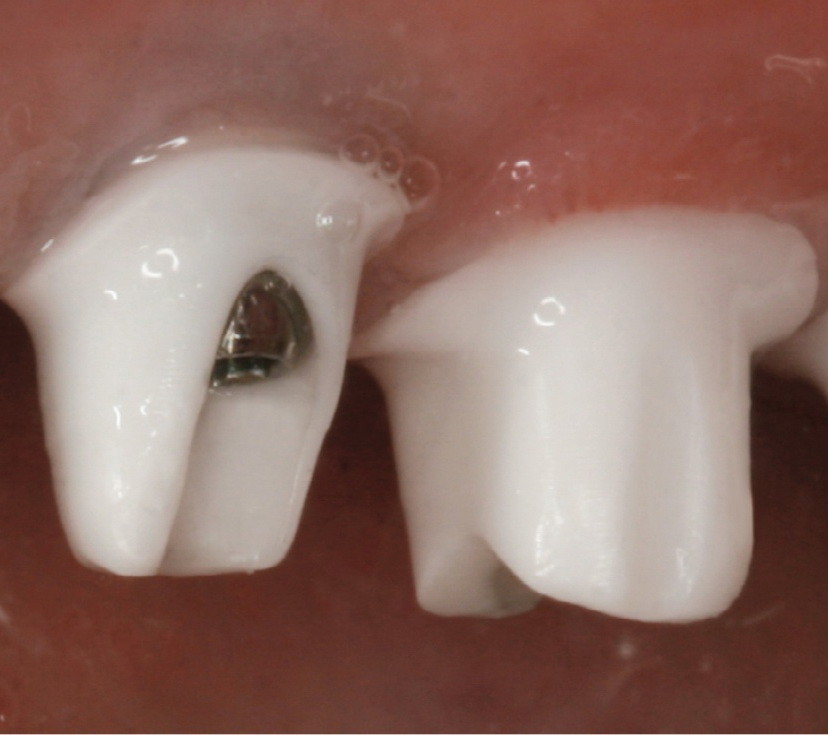 Dental Cement Impla-Cem semi permanent dual curing removable 5ml/8.6gr