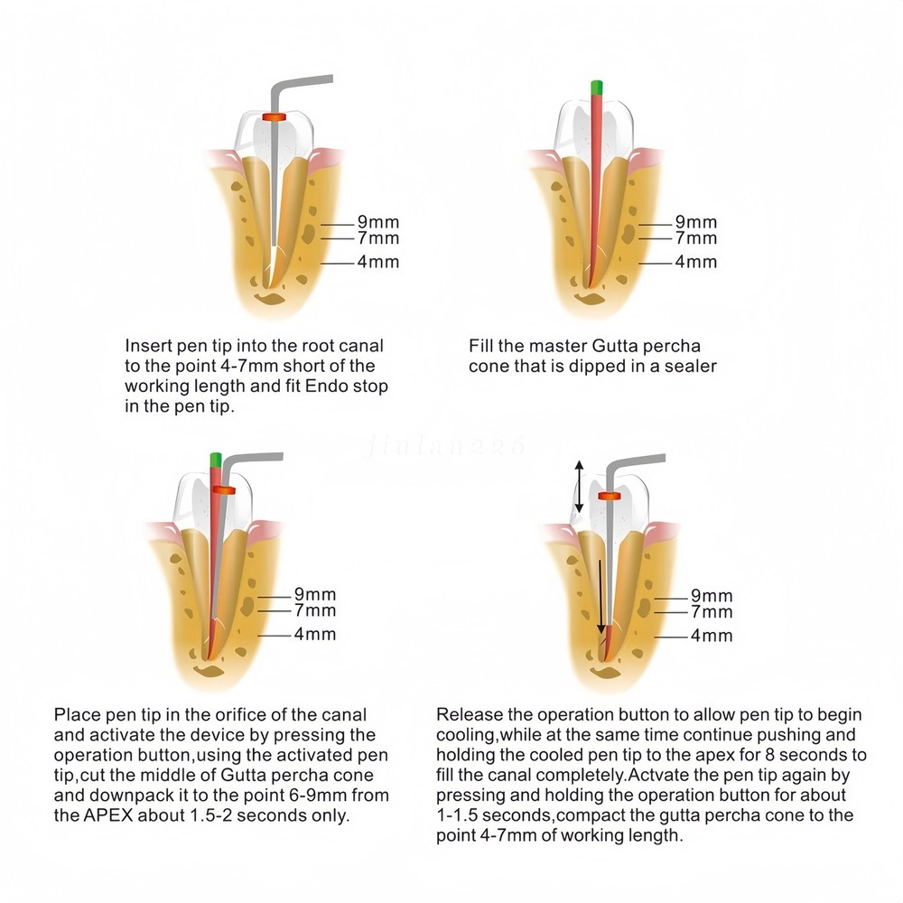 Dental Obturation System Gutta-percha Pen