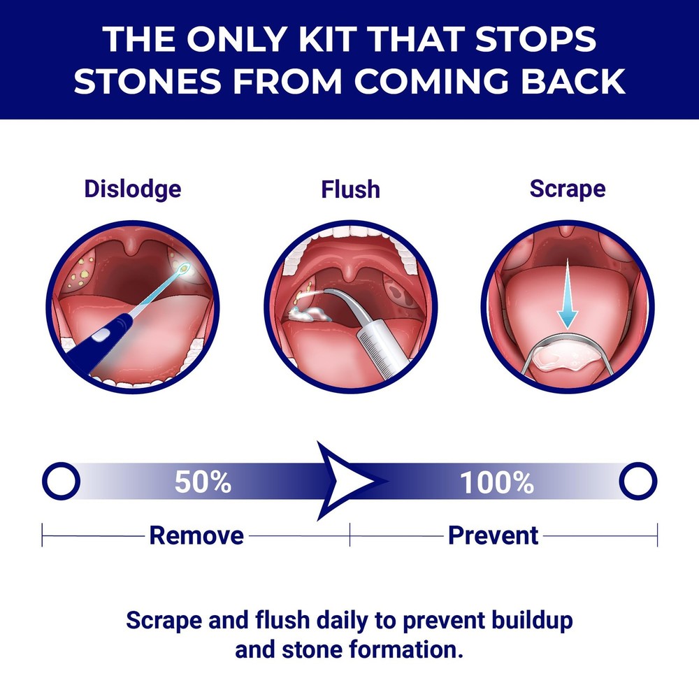 Tonsil Stone Remover - Tonsil Stone Removal Kit - Tonsillolith Remover Tool -...