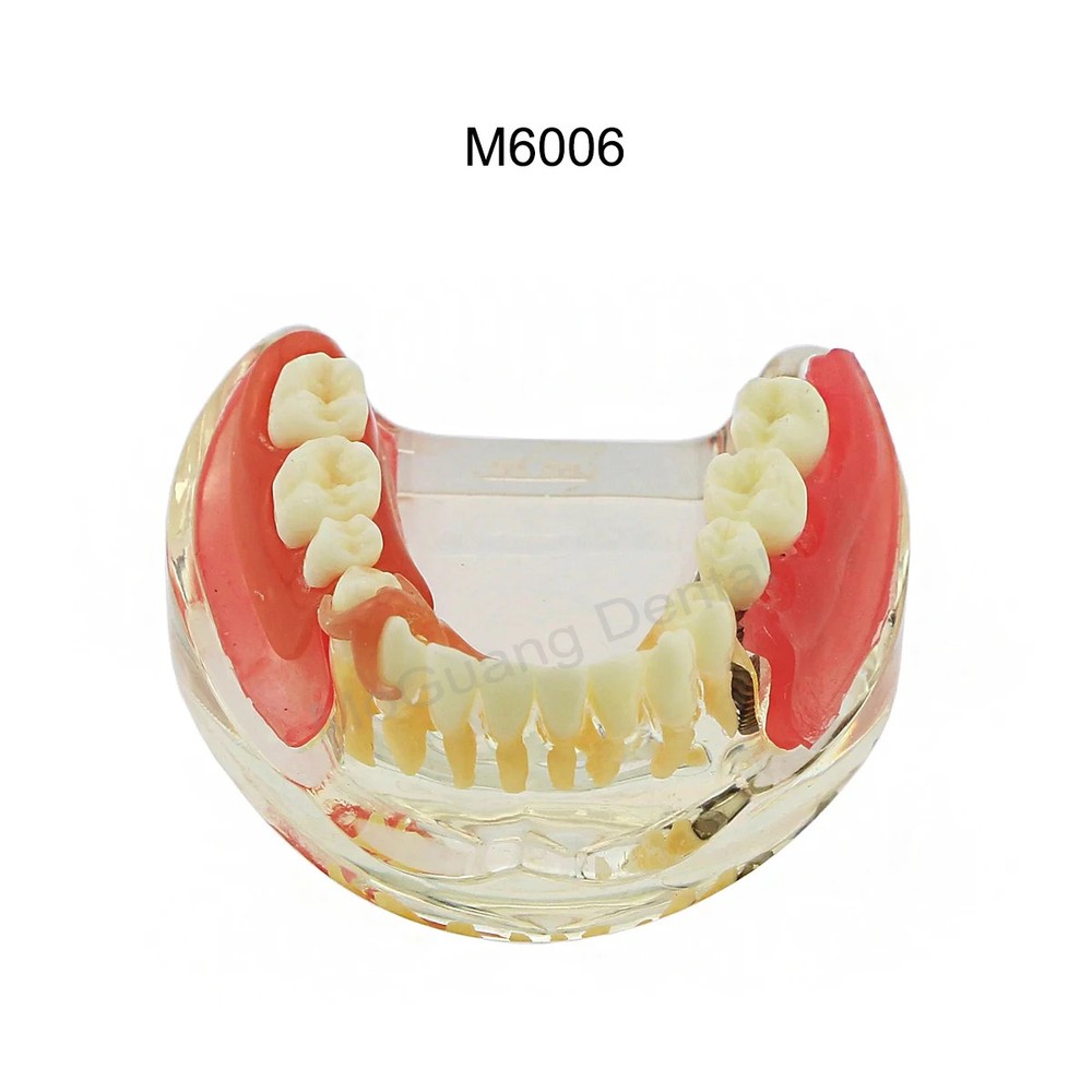 Dental Model with Removable Restorable Teeth Education Model Overdenture Teeth