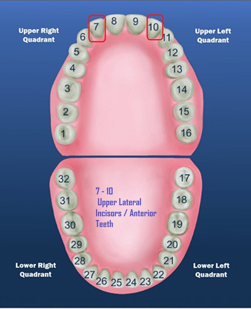 DENTAL POLYCARBONATE TEMPORARY CROWNS #26 (ULL) UPPER LEFT LATERAL 5/PACK