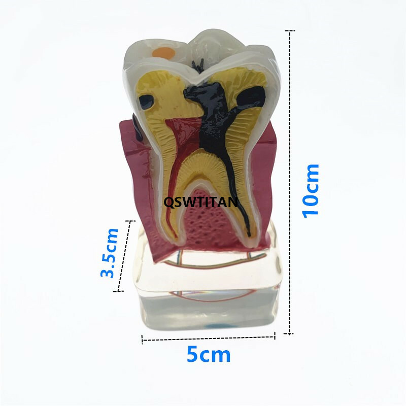 Teeth Model 4 times tooth pathology Comprehensive Periodontal teaching models