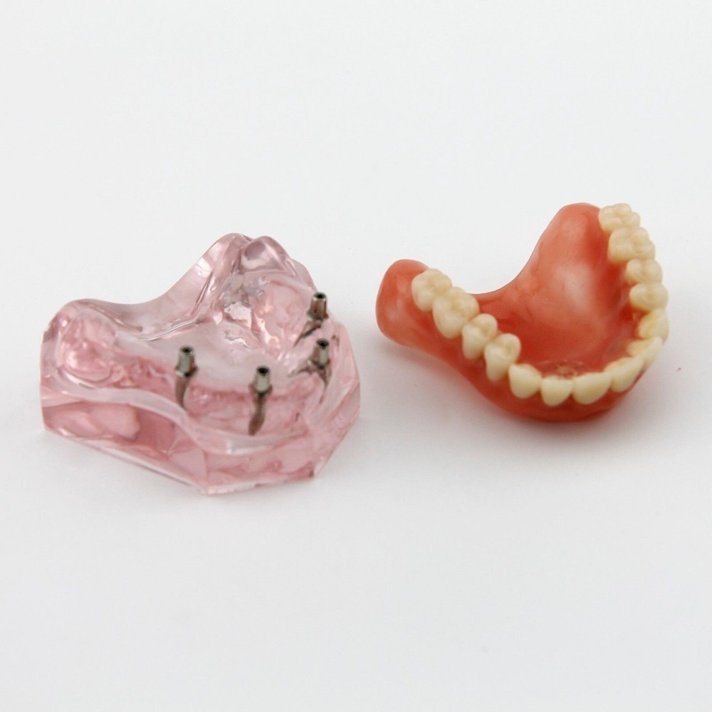 Dental Implant Demo Model Overdenture 4 Implants Maxillary Upper Superior