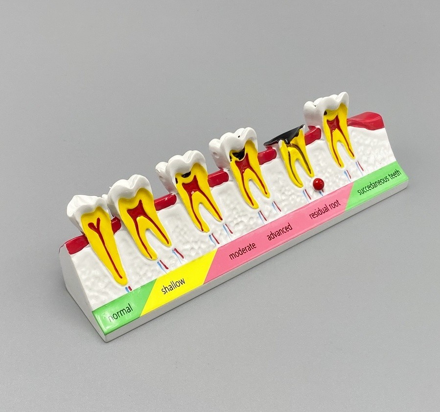 Dental Caries Disease Models Dentoform Typodont Study Teaching Teeth Model Demo