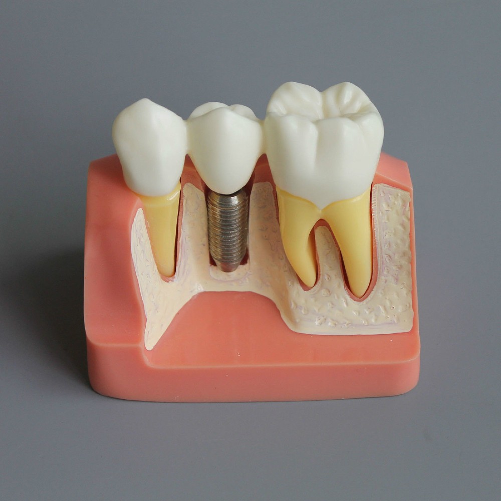 Dental Demonstration Removable Teeth Model Implant Analysis Crown Bridge Study