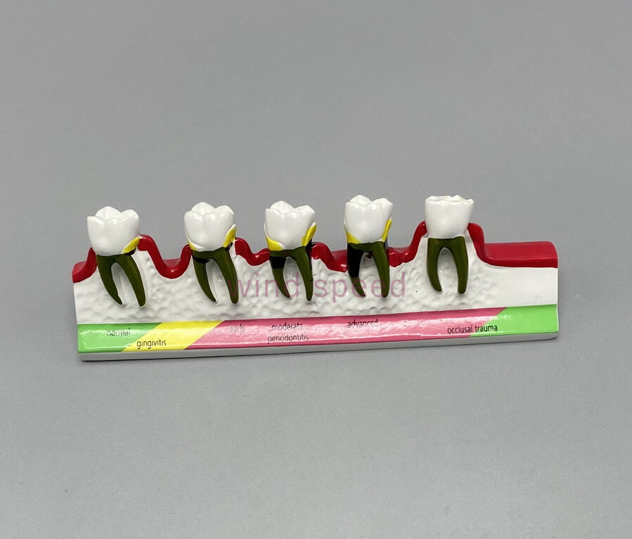Dental Teeth Dentoform Typodont Caries Periodontal Disease Study Teaching Model